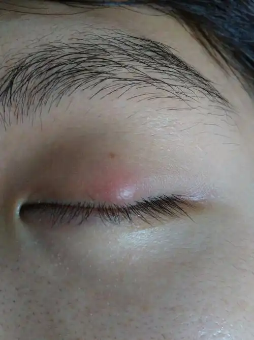 这段时间眼睛一直这样,红肿,不痛,有点痒,也不知道怎么了,我最近在上