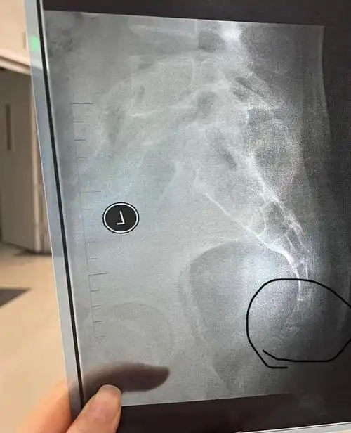 三,治疗效果住院治疗7天后,患者尾椎骨疼痛,肿胀症状较入院前明显减轻