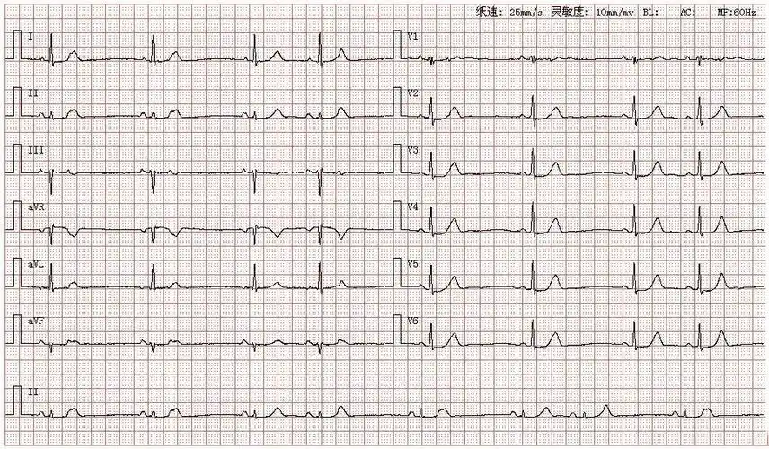 心电图图库丨房性早搏系列 - 知乎