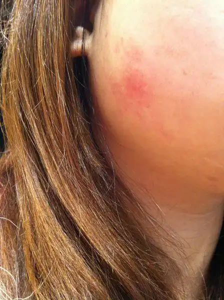 脸色有一块红斑,好久了,不知道是什么原因,可以治得好吗?