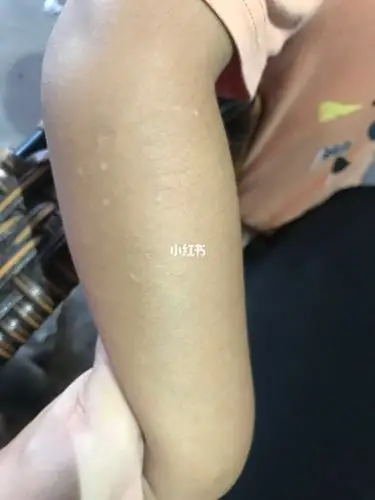 宝宝手上长得小白点是什么?有人知道吗?