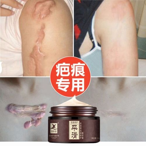 去除增生硬疙瘩胸前凸起修复膏缝针手术凹陷疤痕填充刀疤祛凹凸疤