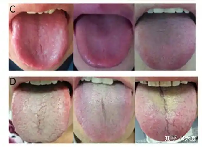 c为健康人的舌苔,d为糜烂性胃炎患者的舌苔 -来源:10.