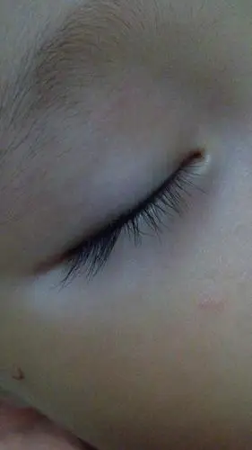 宝宝脸上长了白斑