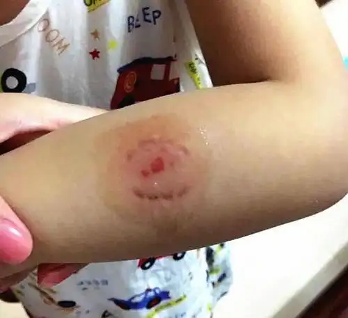 第一次因为那个小朋友想抢宝宝的玩具,宝宝伸手拿回来了.然后被咬.