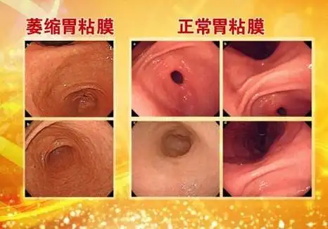 胃镜微观辨证结合中医药辨证治疗萎缩性胃炎