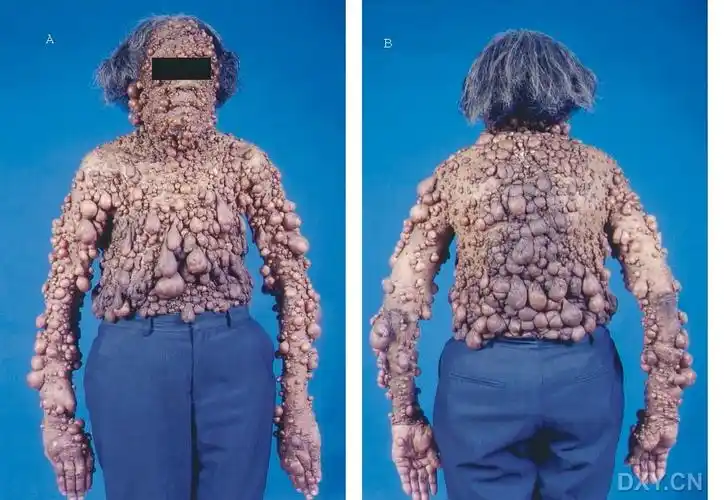 disease and breast cancer) 74岁女性患者,有多发性神经纤维瘤病史