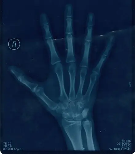 16岁骨骼基本闭合了还能长吗?