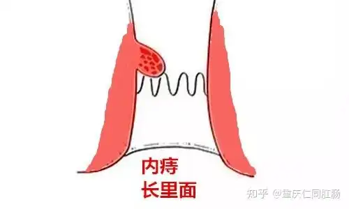 内痔,顾名思义,是长在肛门里面的痔疮,位于在肛管齿状线以上的直肠