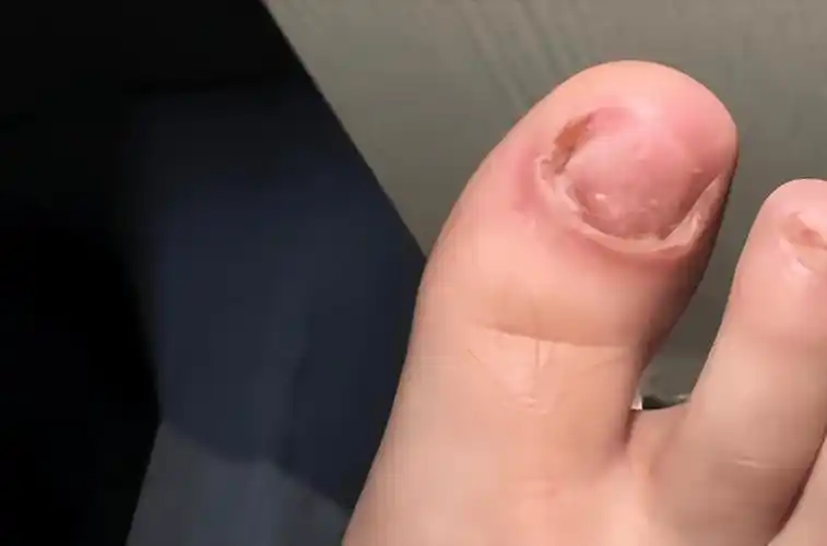 碘伏真的能去除灰指甲,本人亲测有效!