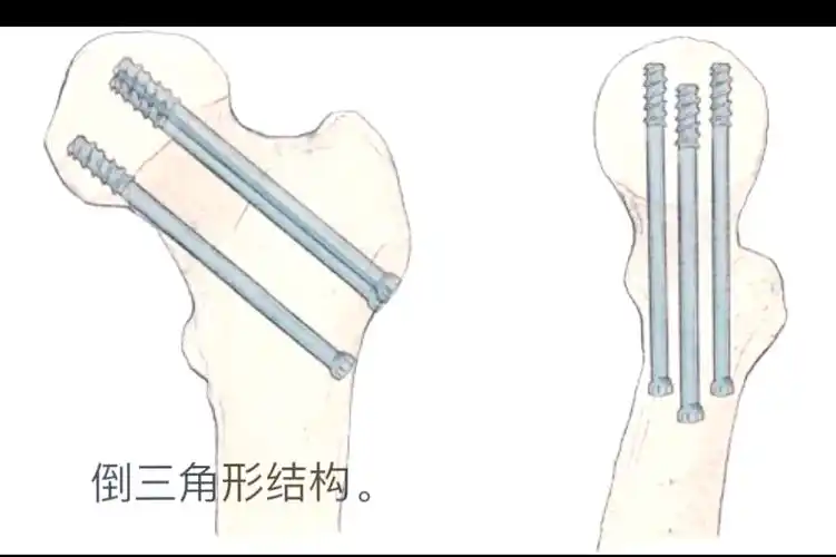 双平面双支撑螺钉固定:骨科手术的新选择