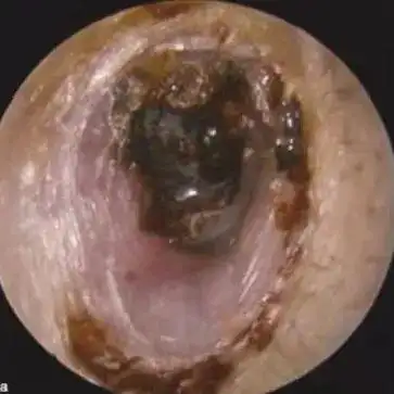 外耳可见痂皮及耵聍清除痂皮后可见鼓膜钙化斑鼓室体瘤耳内镜下透过