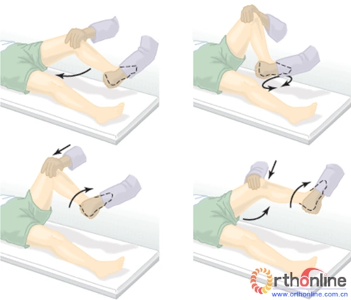 的压痛,可有突出感;典型半月板损伤具有的体征是麦氏征(mcmurrays