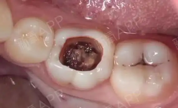 我们叫六龄牙是四胞胎兄弟