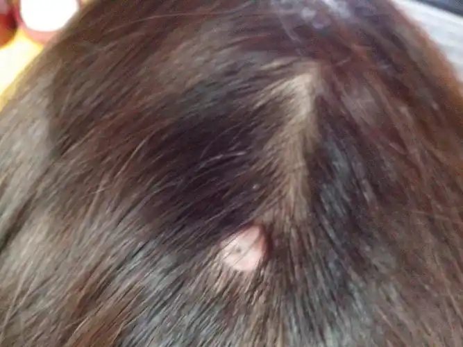 您好,我头上偏后的头皮上长了一颗白色的肉痣,大概一粒花生大