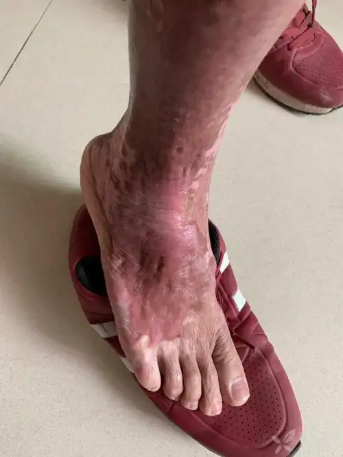 烧烫伤疤痕|主营项目|乐巴康医药官网4008073551疤痕修复项目招商网