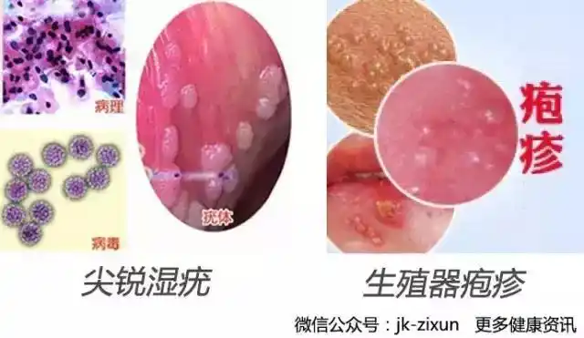 阴茎上有白色颗粒是尖锐湿疣吗 阴茎有白色颗粒警惕3种病-精准抗艾