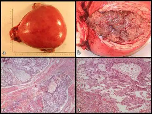 当发现自己怀的是葡萄胎怎么办