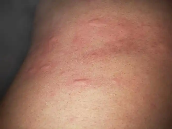 蟑螂在床上爬过,但是我收拾完床铺还是痒,这是怎么回事,是皮肤过敏吗?