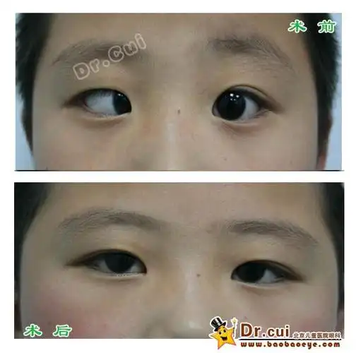 内斜视术前术后照片 - 好大夫在线