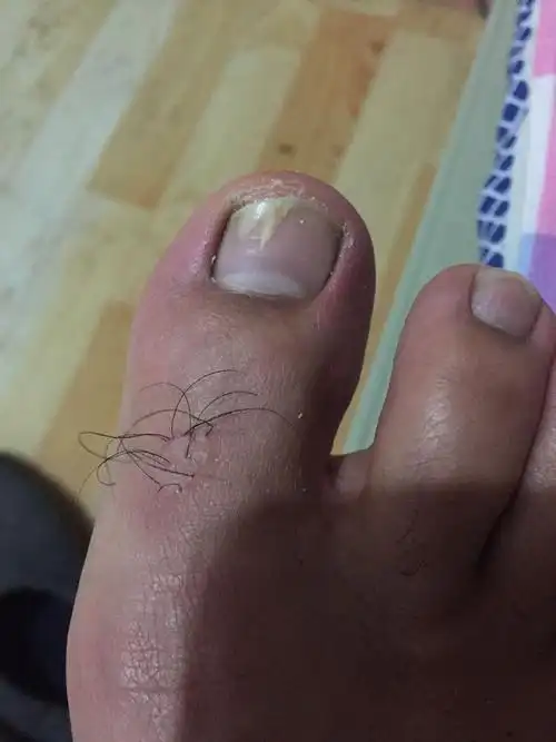 我的大脚甲 有从顶部长向根部的竖纹,而且里面是空的,是不是受到外力