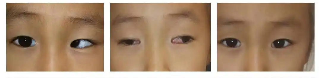 肉毒素斜视治疗的适应症和注意事项