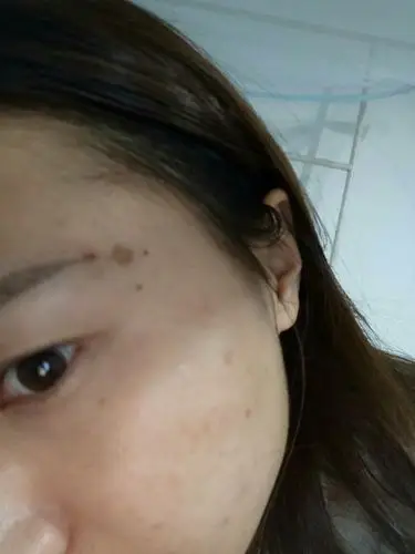 请专家医生帮我看看我这是什么斑,怎么造成的