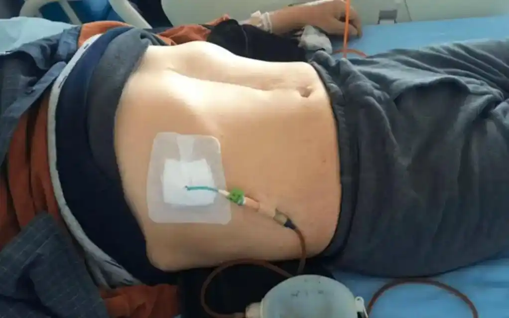 三四年的胃癌中期治疗,穿刺引流手术多次,化疗多次