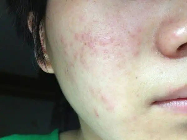 我知道这是闭合性痘痘,那是粉刺还是暗疮呐?或者两者都有?