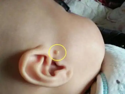 宝宝耳朵上有"拴马桩"代表有福气?快看看你家孩子有没有