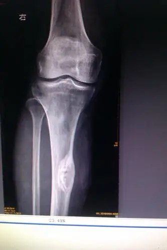 良性骨肿瘤 哪一种?