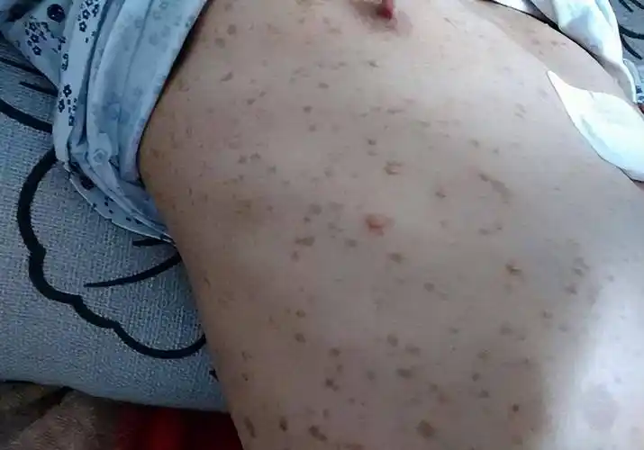 这种咖啡斑不简单,听听外科医生怎么说_孩子_身体_斑点