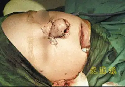 男孩鼻子被狗吃掉 医生在狗肚里找到后缝上(图)