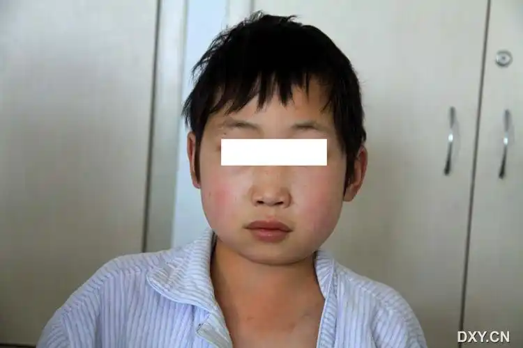 疑难病例:心慌胸闷,双下肢水肿,腹部膨隆5年 [病例帖]