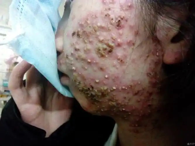脓肿性痤疮还是糠秕孢子菌性毛囊炎?