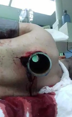 奇迹!俄男子遇车祸被粗钢管穿胸而过仍生还