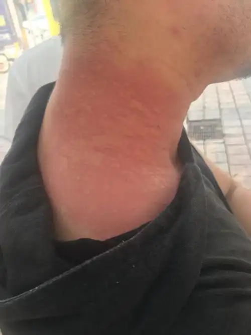 被毛毛虫丁到了,怎么处理,在线等,急急急