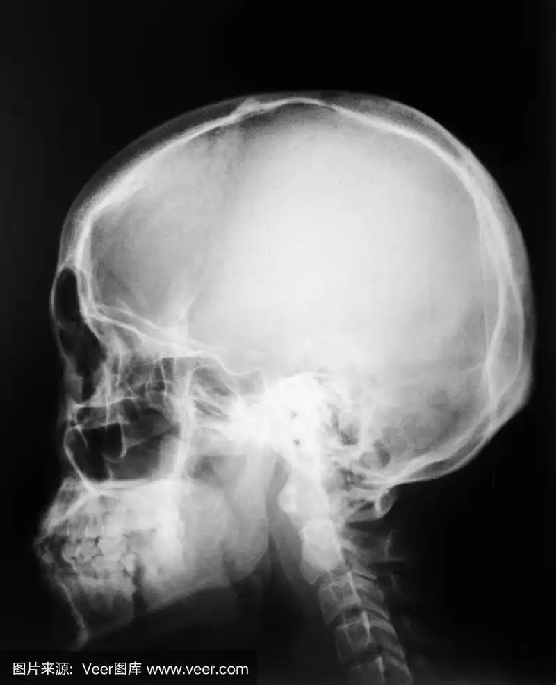 x光片:颅骨外侧