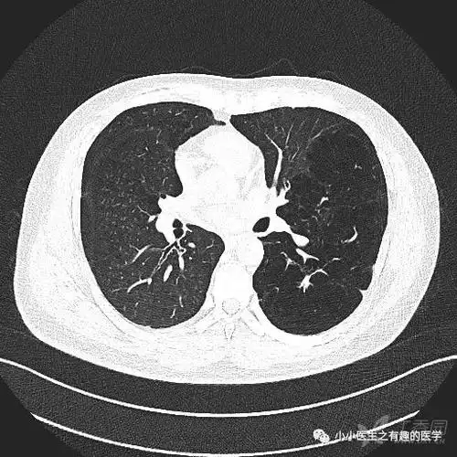 ct经典图谱:肺气肿拿不准?经典ct,3分钟学会