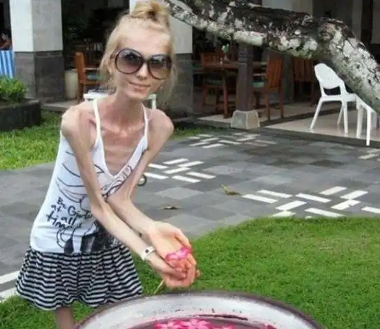 少女患厌食症瘦到26公斤猝死(图)