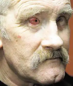 爱尔兰盲人"以牙换眼"重获光明