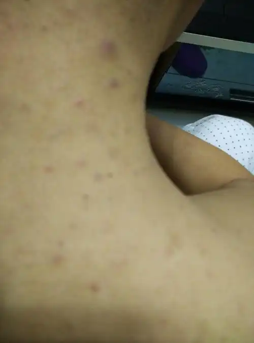 背上长了许多类似黑头的东西,麻烦专家看看该如何处理才能好