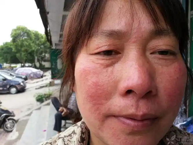 【求助】面部岀疹不痒20天求治