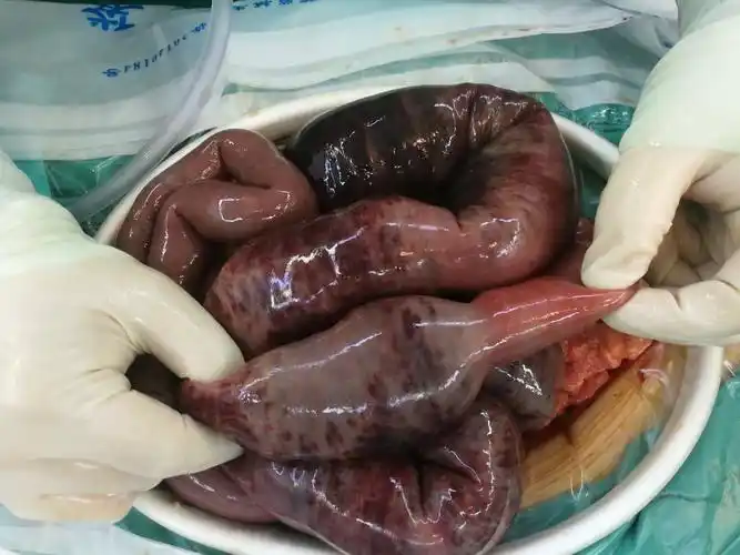 腹壁隧道式空肠营养管置入术的临床应用 - 好大夫在线