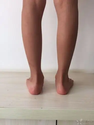 儿童踝关节外翻 - 骨科专业讨论版 -丁香园论坛