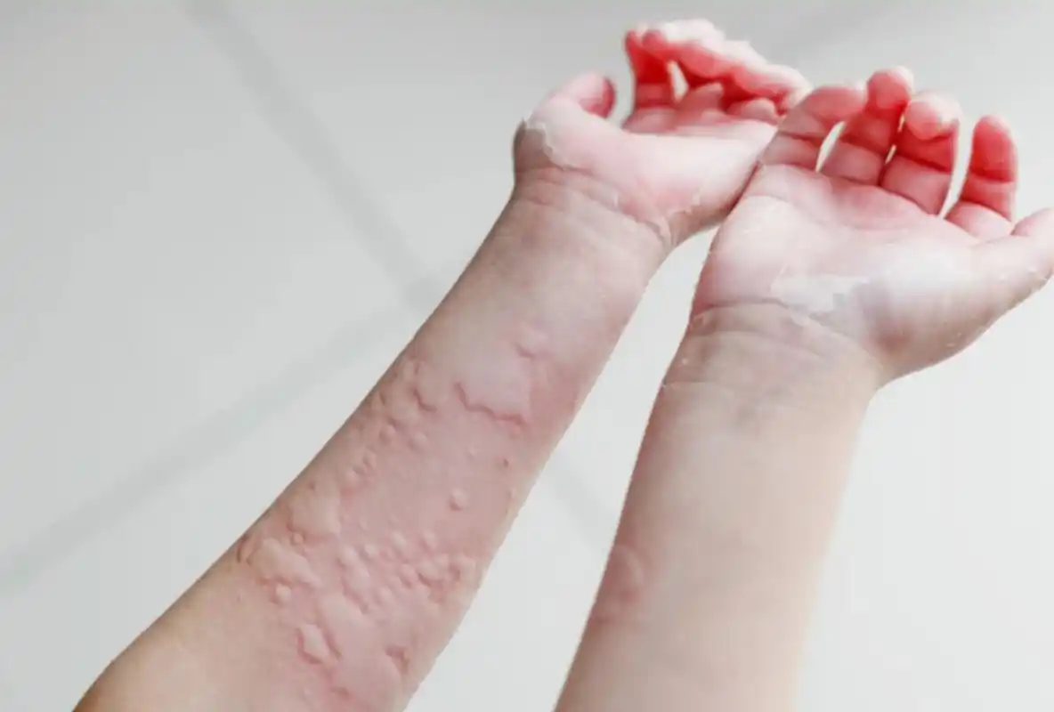 身上出现了一些像蚊虫叮咬一般的大包    非常的痒,这叫荨麻疹,是一