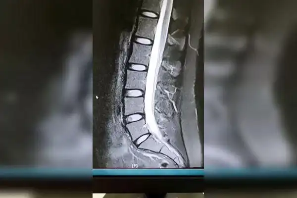 比较正常的腰椎核磁共振扫描,矢状面图像显示_核磁共振_扫描_腰椎