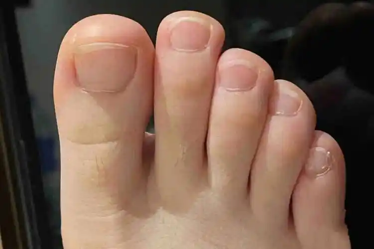 黄厚灰指甲不去拔甲也能掉?按这个方法做!不到30天自己全掉光!