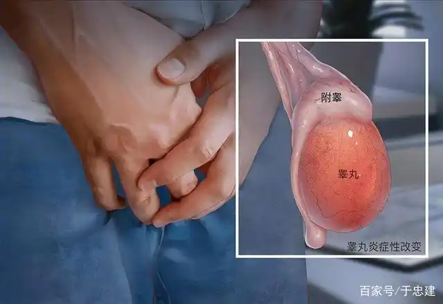 急性睾丸炎如何治疗