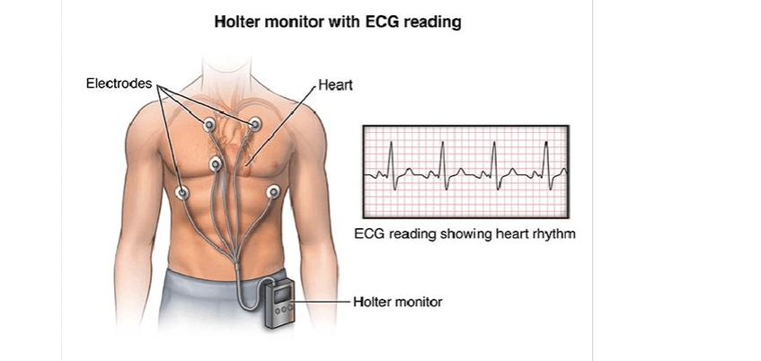 健康科普24小时动态心电图适应症